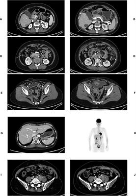 Preliminary Safety and Potential Effect of 6B11-OCIK Adoptive Cell Therapy Against Platinum-Resistant Recurrent or Refractory Ovarian Cancer